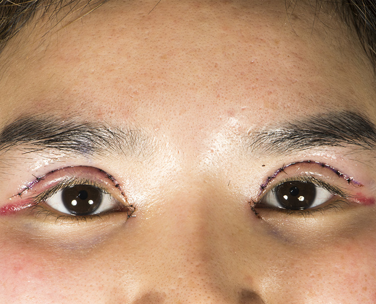 ลดบวมหลังผ่าตัด